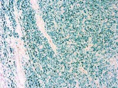 Immunohistochemistry-Paraffin: Rapid Tissue Preservation Solution [NBP3-12177] - Formalin fixed paraffin embedded human Melanoma stained with Melanoma antibody using Rapid Tissue Preservation Solution (NBP3-12177)