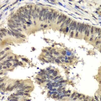 Immunohistochemistry-Paraffin: RbBP5 Antibody [NBP2-95234] -  Human colon carcinoma using RBBP5 antibody at dilution of 1:100 (40x lens).Perform microwave antigen retrieval with 10 mM PBS buffer pH 7.2 before commencing with IHC staining protocol.