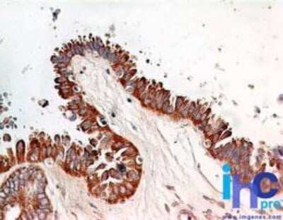 Immunohistochemistry-Paraffin: RelA/NFkB p65 Antibody (112A1021) - Azide Free [NBP2-27416] - Formalin-fixed, paraffin-embedded ovarian cystadenocarcinoma probed with p65 antibody at 5 ug/ml. Human tissue TMA was used for this test.    Staining of formalin-fixed tissues is enhanced by boiling tissue sections in 10 mM sodium citrate buffer, pH 6.0 for 10-20 min followed by cooling at RT for 20 min.