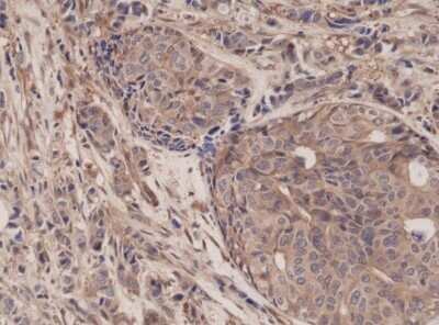 Immunohistochemistry-Paraffin: RelA/NFkB p65 Antibody (RM273) [NBP2-61583] - Immunohistochemical staining of formalin fixed and paraffin embedded Human breast cancer tissue sections using NBP2-61583.