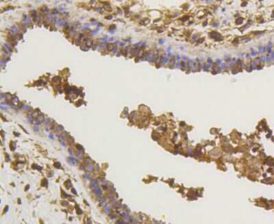 Immunohistochemistry-Paraffin: RelA/NFkB p65 NLS Antibody (SZ10-04) [NBP2-67352] - Analysis of paraffin-embedded human breast carcinoma tissue using anti-NF-kB p65 antibody. Counter stained with hematoxylin.
