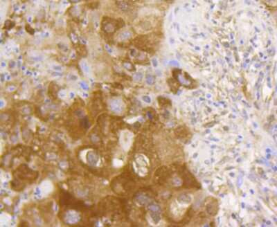 Immunohistochemistry-Paraffin: RelA/NFkB p65 NLS Antibody (SZ10-04) [NBP2-67352] - Analysis of paraffin-embedded human lung cancer tissue using anti-NF-kB p65 antibody. Counter stained with hematoxylin.