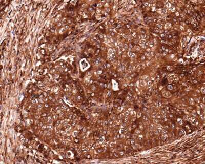 Immunohistochemistry-Paraffin: RelA/NFkB p65 NLS Antibody (SZ10-04) [NBP2-67352] - Analysis of paraffin-embedded human lung squamous cell carcinoma tissue with Rabbit anti-RelA/NFkB p65 antibody washed with ddH2O and PBS, and then probed with the primary antibody  at 1/400 dilution for 1 hour at room temperature. The detection was performed using an HRP conjugated compact polymer system. DAB was used as the chromogen. Tissues were counterstained with hematoxylin and mounted with DPX.