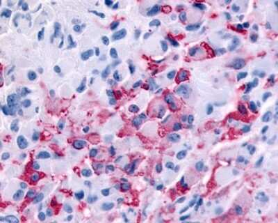 Immunohistochemistry-Paraffin: Relaxin R2/LGR8 Antibody [NLS4751] - Analysis of anti-RXFP2 / LGR8 antibody with human brain, glioblastoma.