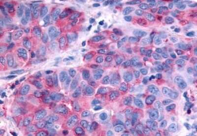 Immunohistochemistry-Paraffin: Relaxin R2/LGR8 Antibody [NLS4751] - Anti-RXFP2 / LGR8 antibody IHC of human Lung, Non-Small Cell Carcinoma. Immunohistochemistry of formalin-fixed, paraffin-embedded tissue after heat-induced antigen retrieval.