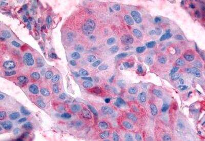 Immunohistochemistry-Paraffin: Relaxin R2/LGR8 Antibody [NLS4751] - Breast, carcinoma