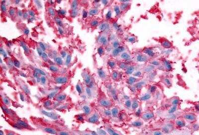 Immunohistochemistry-Paraffin: Relaxin R2/LGR8 Antibody [NLS4751] - Skin, Malignant Melanoma