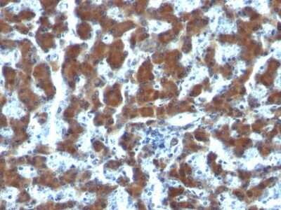 Immunohistochemistry-Paraffin: Retinol Binding Protein RBP Antibody (G4E4) - Azide and BSA Free [NBP2-34622] - Formalin-fixed, paraffin-embedded human Hepatocellular Carcinoma stained with Retinol Binding Protein RBP Antibody (G4E4).