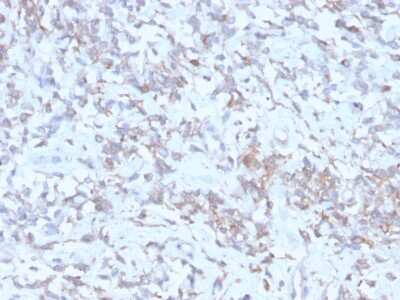 Immunohistochemistry-Paraffin: Retinol Binding Protein RBP Antibody (rRBP1/872) - Azide and BSA Free [NBP3-08941] - Formalin-fixed, paraffin-embedded human Hepatocellular Carcinoma stained with Retinol Binding Protein RBP Recombinant Mouse Monoclonal Antibody (rRetinol Binding Protein RBP/872).