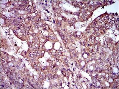 Immunohistochemistry: Rex-1/ZFP42 Antibody (5E11E7) [NBP2-37360] - Immunohistochemical analysis of paraffin-embedded rectum cancer tissues using ZFP42 mouse mAb with DAB staining.