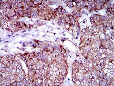 Immunohistochemistry: Rex-1/ZFP42 Antibody (5E11E7) [NBP2-37360] - Immunohistochemical analysis of paraffin-embedded esophagus cancer tissues using ZFP42 mouse mAb with DAB staining.