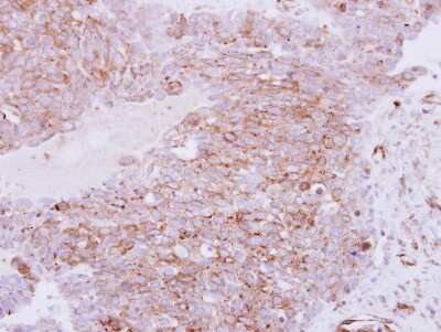 Immunohistochemistry-Paraffin: RhoC Antibody [NBP2-20156] - Immunohistochemical analysis of paraffin-embedded Ovarian carcinoma, using antibody at 1:250 dilution.