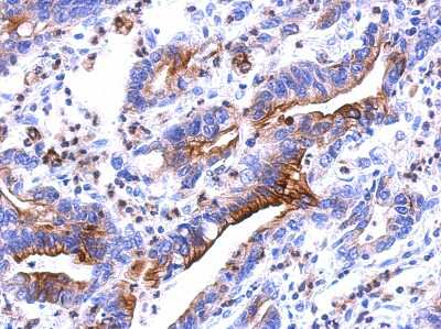 Immunohistochemistry-Paraffin: RhoF Antibody [NBP2-20157] - Immunohistochemical analysis of paraffin-embedded colon ca, using antibody at 1:500 dilution.