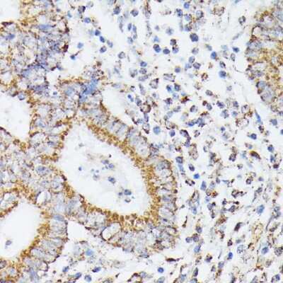 Immunohistochemistry-Paraffin: RhoG Antibody [NBP3-15747] - Immunohistochemistry of paraffin-embedded human colon carcinoma using RhoG antibody (NBP3-15747) at dilution of 1:100 (40x lens).Perform microwave antigen retrieval with 10 mM PBS buffer pH 7.2 before commencing with IHC staining protocol.