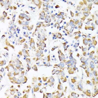 Immunohistochemistry-Paraffin: RhoG Antibody [NBP3-15747] - Immunohistochemistry of paraffin-embedded human liver cancer using RhoG antibody (NBP3-15747) at dilution of 1:100 (40x lens).Perform microwave antigen retrieval with 10 mM PBS buffer pH 7.2 before commencing with IHC staining protocol.