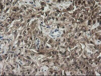 Immunohistochemistry: RhoJ Antibody (OTI1D7) [NBP2-45590] - Analysis of Carcinoma of Human kidney tissue.