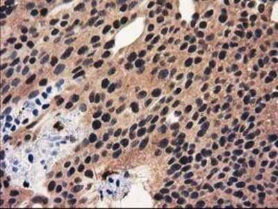 Immunohistochemistry: Ribonuclease Inhibitor Antibody (OTI1B7) - Azide and BSA Free [NBP2-73896] - Staining of paraffin-embedded Carcinoma of Human bladder tissue using anti-Ribonuclease Inhibitor mouse monoclonal antibody.
