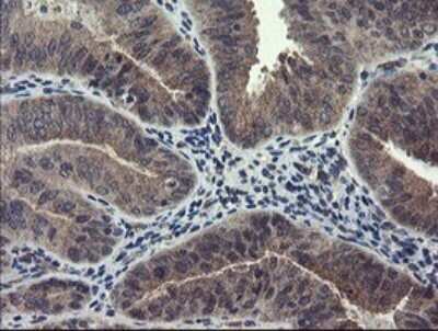 Immunohistochemistry: Ribophorin I Antibody (OTI5B1) [NBP2-45633] - Analysis of Adenocarcinoma of Human endometrium tissue. (Heat-induced epitope retrieval by 10mM citric buffer, pH6.0, 120C for 3min)