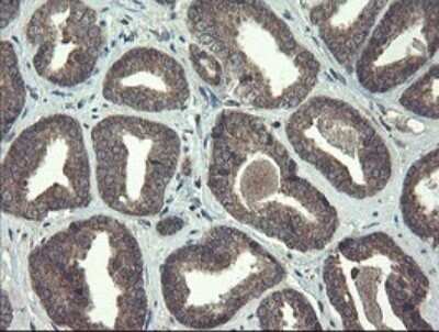 Immunohistochemistry: Ribophorin I Antibody (OTI5B1) [NBP2-45633] - Analysis of Carcinoma of Human prostate tissue. (Heat-induced epitope retrieval by 10mM citric buffer, pH6.0, 120C for 3min)