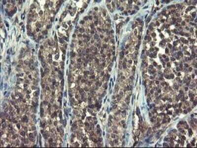 Immunohistochemistry: Ribophorin I Antibody (OTI5B1) [NBP2-45633] - Analysis of Carcinoma of Human thyroid tissue. (Heat-induced epitope retrieval by 10mM citric buffer, pH6.0, 120C for 3min)