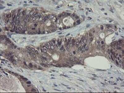 Immunohistochemistry: Ribophorin I Antibody (OTI5B1) [NBP2-45633] - Analysis of Adenocarcinoma of Human colon tissue. (Heat-induced epitope retrieval by 10mM citric buffer, pH6.0, 120C for 3min)