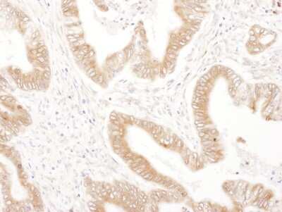 <b>Biological Strategies Validation. </b>Immunohistochemistry: Ribophorin II Antibody [NBP2-32178] - Sample: FFPE section of human prostate carcinoma. Antibody: Affinity purified rabbit anti- RPN2 used at a dilution of 1:1,000 (1ug/ml). Detection: DAB. Counterstain: IHC Hematoxylin (blue).