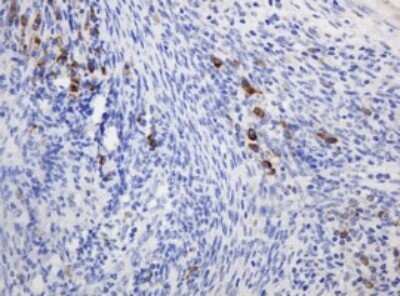 Immunohistochemistry: Ribophorin II Antibody (OTI1G9) - Azide and BSA Free [NBP2-73907] - Analysis of Adenocarcinoma of Human endometrium tissue. (Heat-induced epitope retrieval by 10mM citric buffer, pH6.0, 120C for 3min)