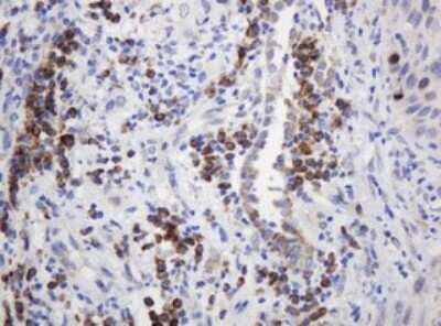 Immunohistochemistry: Ribophorin II Antibody (OTI1G9) - Azide and BSA Free [NBP2-73907] - Analysis of Carcinoma of Human lung tissue.(Heat-induced epitope retrieval by 10mM citric buffer, pH6.0, 120C for 3min)