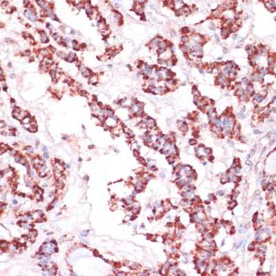 Immunohistochemistry-Paraffin: Ribosomal Protein L24 Antibody [NBP2-93788] - Paraffin-embedded human thyroid cancer using Ribosomal Protein L24 .