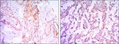 Immunohistochemistry-Paraffin: Rictor Antibody (7B3) - Azide and BSA Free [NBP2-80925] - Immunohistochemical analysis of paraffin-embedded thyroid gland tissues (left) and human breast carcinoma (right) using RICTOR mouse mAb with DAB staining. Image from the standard format of this antibody.