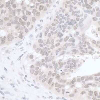 <b>Biological Strategies Validation. </b>Immunohistochemistry-Paraffin: Rif1 Antibody [NB100-1586] - Sample: FFPE section of human ovarian carcinoma. Antibody: Affinity purified rabbit anti- RIF1 used at a dilution of 1:1,000 (1ug/ml). Detection: DAB. Counterstain: IHC Hematoxylin (blue).