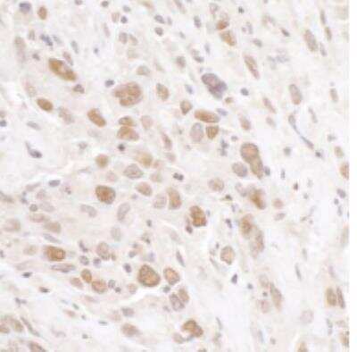 <b>Biological Strategies Validation. </b>Immunohistochemistry-Paraffin: Rif1 Antibody [NB100-1587] - Section of human breast carcinoma. Antibody: Affinity purified rabbit anti-RIF1 used at a dilution of 1:1,000 (1ug/ml). Detection: DAB.