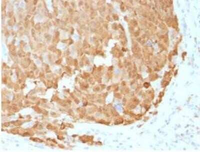 Immunohistochemistry-Paraffin: S100A1 Antibody (S100A1/1942) - Azide and BSA Free [NBP2-59617] - Formalin-fixed, paraffin-embedded human Melanoma stained with S100A1 Mouse Monoclonal Antibody (S100A1/1942)