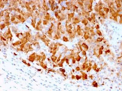 Immunohistochemistry-Paraffin: S100A1 Antibody (S100A1/1942) - Azide and BSA Free [NBP2-59617] - Formalin-fixed, paraffin-embedded human Melanoma stained with S100A1 Antibody (S100A1/1942).