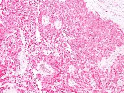 Immunohistochemistry-Paraffin: S100A1 Antibody (SPM354) - IHC-Prediluted [NBP2-44591] - Formalin-fixed, paraffin-embedded human melanoma stained with S100 MAb (SPM354).