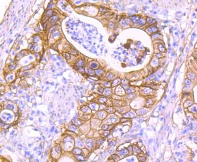 Immunohistochemistry-Paraffin: S100A10 Antibody (JF0987) [NBP2-67122] - Analysis of paraffin-embedded human gastric carcinoma tissue using anti-S100A10 antibody. Counter stained with hematoxylin.