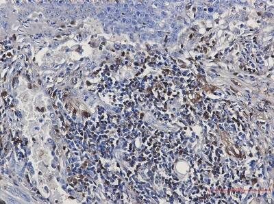 Immunohistochemistry-Paraffin: S100A4 Antibody (S01-7H1) [NBP3-19607] - Immunohistochemistry of S100A4 in paraffin-embedded Human lung cancer tissue using NBP3-19607 at dilution 1/50