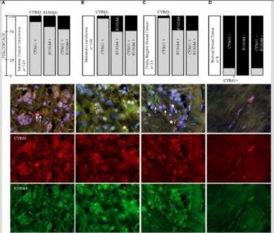 S100A4 Antibody (S100A4/1481) [Alexa Fluor® 488] [NBP2-54580AF488] - 3 tissue arrays with 104 invasive ductal carcinoma tissue sections with metastatic carcinomas, 21 invasive ductal carcinoma tissue sections, & 8 normal tissue sections. 33 carcinoma tissue sections were -ve for estrogen & progesterone receptor; don't overexpress Her2neu receptor (triple -ve  breast cancer, TNBC). (A) CYR61 &/or S100A4 expression analysis in 123 invasive ductal carcinoma tissue & lymph node sections of 104 patients (B); representative ICC/IF stains analyzed with 100x oil objective. (C) From 123 invasive ductal carcinomas tissue sections, 33 stated as being TNBC. (D) Normal breast tissue sections (n = 8) analyzed for CYR61 &/ or S100A4 expression using ICC/IF. Scale bar: 20 um. Image collected & cropped by CiteAb from the following publication (//www.frontiersin.org/article/10.3389/fonc.2019.01074/full), licensed under a CC-BY license.