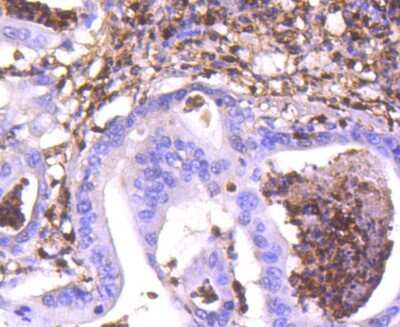 Immunohistochemistry-Paraffin: S100A4 Antibody (SD200-08) [NBP2-67740] - Analysis of paraffin-embedded human gastric carcinoma tissue using anti-S100A4 antibody. Counter stained with hematoxylin.