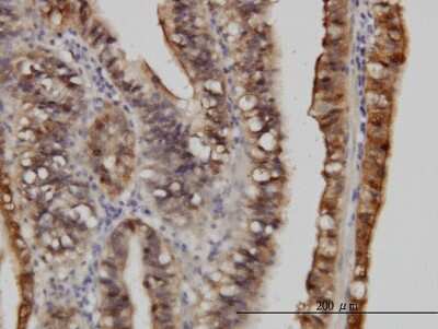 Immunohistochemistry-Paraffin: S100A6 Antibody (6B5) [H00006277-M10] - Analysis of monoclonal antibody to S100A6 on formalin-fixed paraffin-embedded human stomach carcinoma. Antibody concentration 3 ug/ml