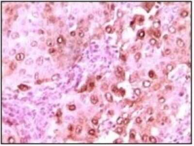 Immunohistochemistry-Paraffin: S100A6 Antibody (7D11A8) [NB100-1765] - Analysis of human brain glioma tissue showing nuclear localization using calcyclin mouse mAb with DAB staining.