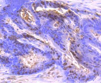 Immunohistochemistry-Paraffin: S100A6 Antibody (JF0976) [NBP2-67123] - Analysis of paraffin-embedded human colon cancer tissue using anti-S100 alpha 6 antibody. Counter stained with hematoxylin.