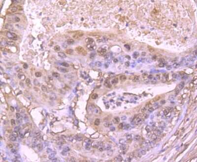 Immunohistochemistry-Paraffin: S100A6 Antibody (JF0976) [NBP2-67123] - Analysis of paraffin-embedded human gastric carcinoma tissue using anti-S100 alpha 6 antibody. Counter stained with hematoxylin.