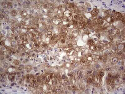 Immunohistochemistry: S100A6 Antibody (OTI5A10) - Azide and BSA Free [NBP2-73969] - Analysis of Carcinoma of Human lung tissue.(Heat-induced epitope retrieval by 1 mM EDTA in 10mM Tris, pH8.5, 120C for 3min)