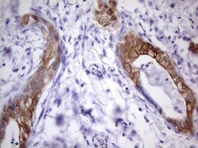 Immunohistochemistry: S100A6 Antibody (OTI5A10) - Azide and BSA Free [NBP2-73969] - Analysis of Carcinoma of Human pancreas tissue. (Heat-induced epitope retrieval by 1 mM EDTA in 10mM Tris, pH8.5, 120C for 3min)