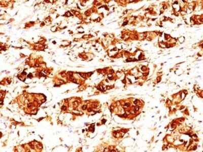 Immunohistochemistry-Paraffin: S100A7/Psoriasin Antibody (47C1068) - Azide Free [NBP2-24911] - Formalin-fixed, paraffin-embedded human breast tissue stained with psoriasin antibody at 1:200 using peroxidase-conjugate and DAB chromogen. Antigen retrieval with citrate buffer, pH 6.