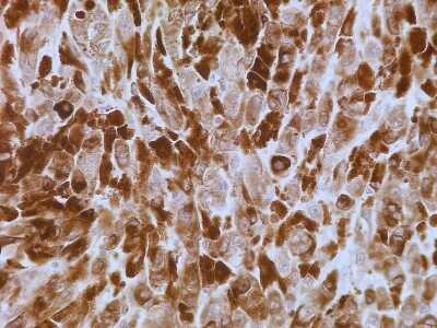 Immunohistochemistry-Paraffin: S100A7/Psoriasin Antibody (47C1068) - Azide Free [NBP2-24911] - IHC analysis of formalin-fixed paraffin-embedded tissue section of human lymph node cancer using 5 ug/ml concentration of Psoriasin/S100A7 antibody (clone 47C1068). Very strong cytoplasmic immunopositivity of Psoriasin/S100A7 protein was observed in the cancer cells.