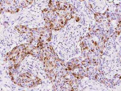 Immunohistochemistry-Paraffin: S100A8 Antibody (216) [NBP2-89808] - Staining of human S100A8 in human breast carcinoma with rabbit monoclonal antibody at 1:2000 dilution.