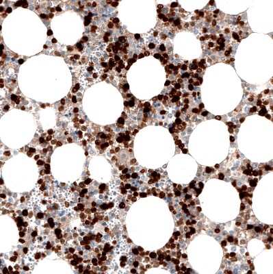 Immunohistochemistry-Paraffin: S100A8 Antibody (CL11171) [NBP3-07985] - Staining of human bone marrow shows strong cytoplasmic positivity in hematopoietic cells.