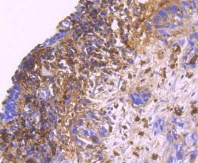 Immunohistochemistry-Paraffin: S100A9 Antibody (JF096-8) [NBP2-67124] - Analysis of paraffin-embedded human breast carcinoma tissue using anti-S100A9 antibody. Counter stained with hematoxylin.